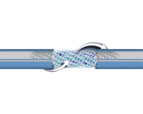 Slangreparatie met stent om de doorstroming te herstellen